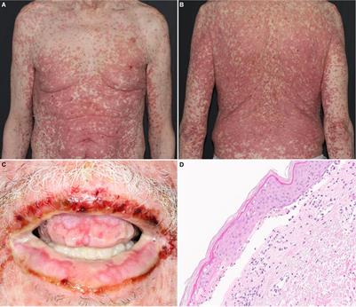 High Grade Dermatologic Adverse Events Associated With Immune Checkpoint Blockade for Cancer